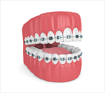 6 Benefits of Straight Teeth - West Palm Beach Dentist